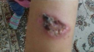 انتقاد به سالک درباره‌ی شیوع سالک