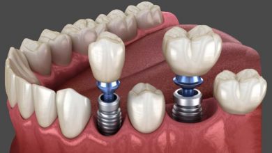 انواع-ایمپلنت-دندان