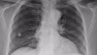 شیوع سل در سیستان و بلوچستان بالاتر از میانگین کشوری