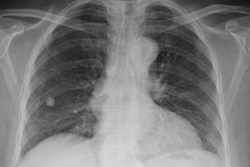 شیوع سل در سیستان‌ و بلوچستان بالاتر از میانگین کشوری
