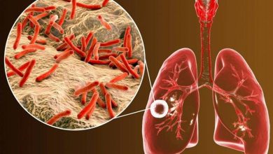 درمان رایگان سل در لرستان