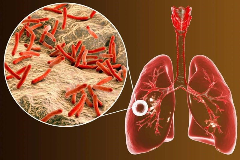 درمان رایگان سل در لرستان